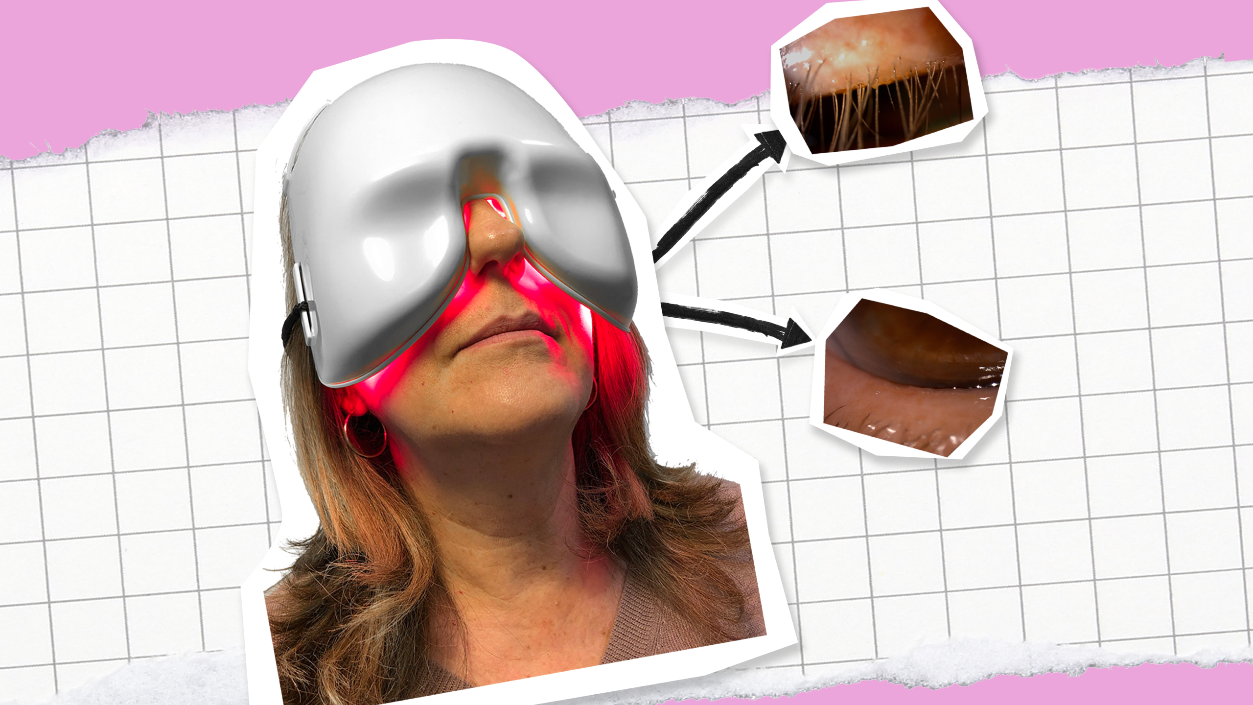 A picture with a cut out of a woman using the Espansione eye-light® – for OPE® IPL and LM® LLLT Dry-Eye treatment, with pictures of demodex-associated blepharitis before and after the light therapy with a pink and grid style paper